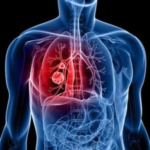 1394170590_big_0lungcancerMain
